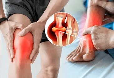 Icexini geeli kandmise skeem põlveliigese ja jalalaba piirkonda