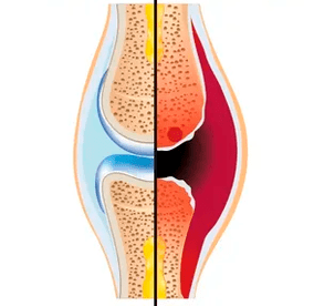 Terve ja kulunud liigese struktuur koos kõhrekoe ja sünoviaalvedeliku tähistusega